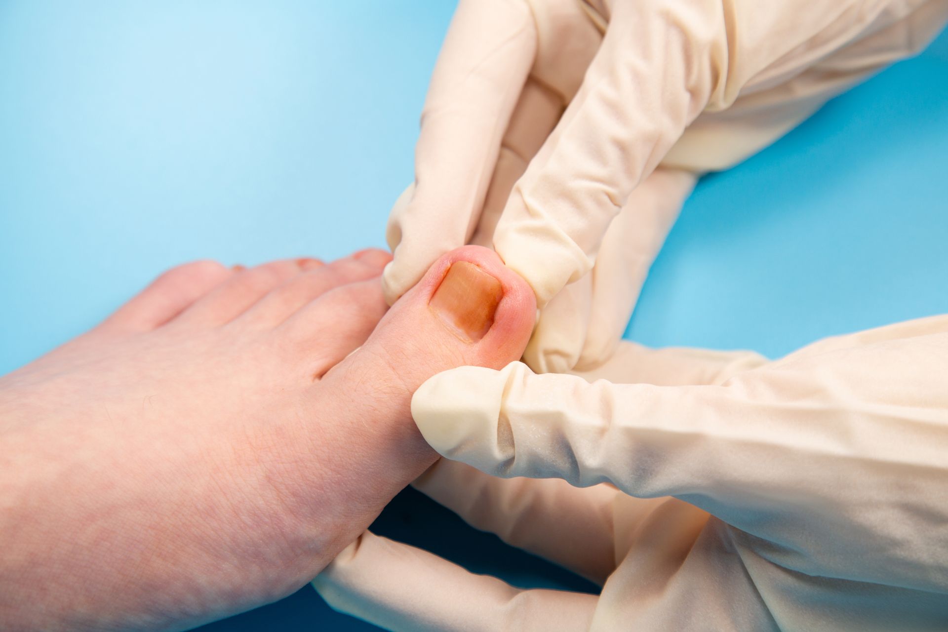 Toe with yellowed toenail being examined by gloved hands against a blue background.