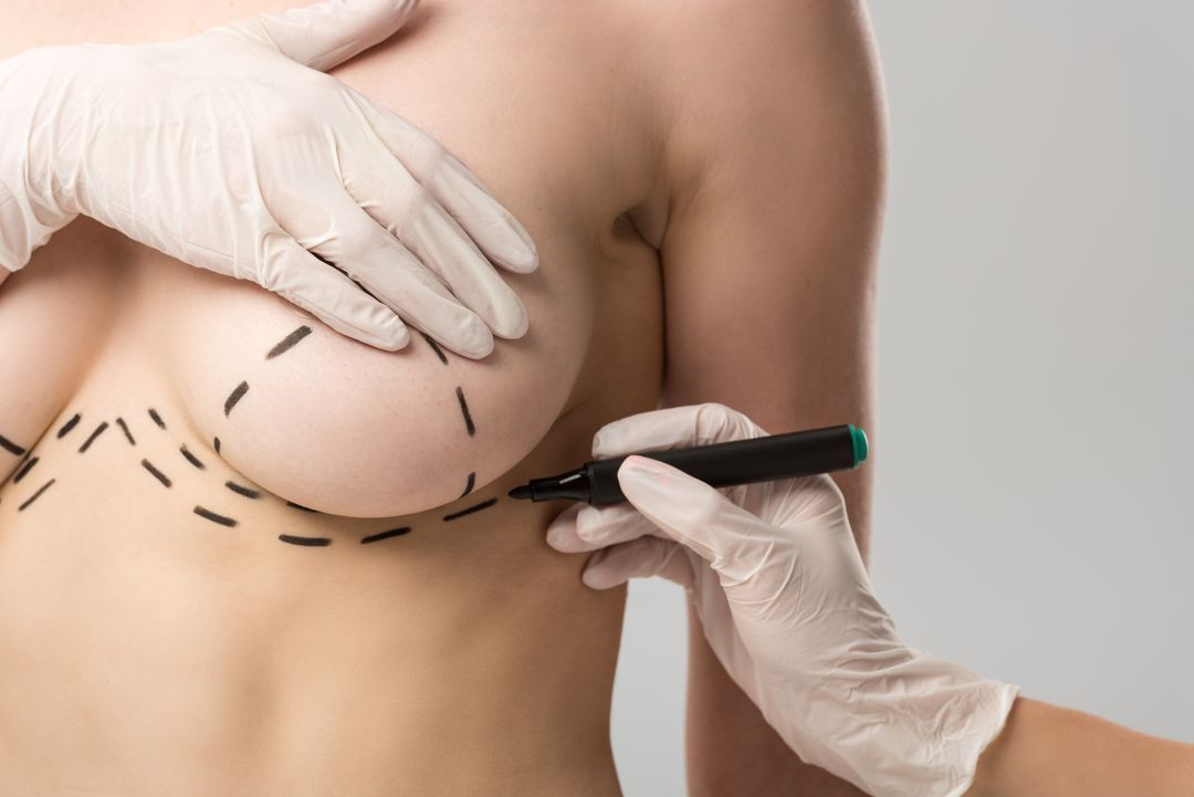 Breast marked with surgical lines; gloved hands hold a marker.