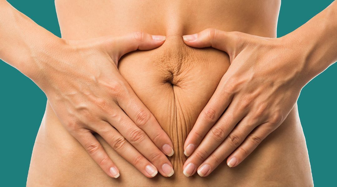 Hands cupping and pinching belly skin, showing folds and wrinkles around the navel.