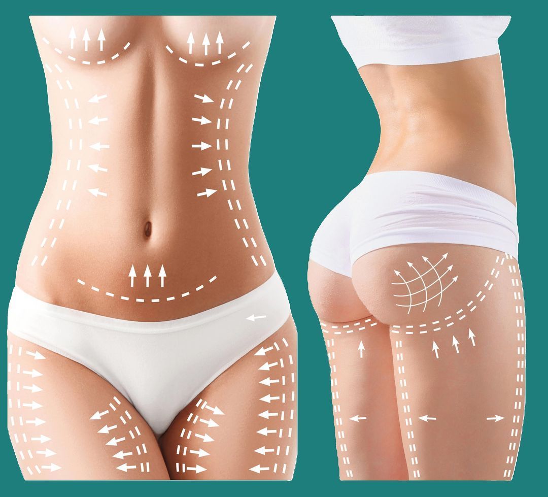 Woman's body with arrows and dashed lines illustrating cosmetic procedures on abdomen, hips, thighs, and buttocks.