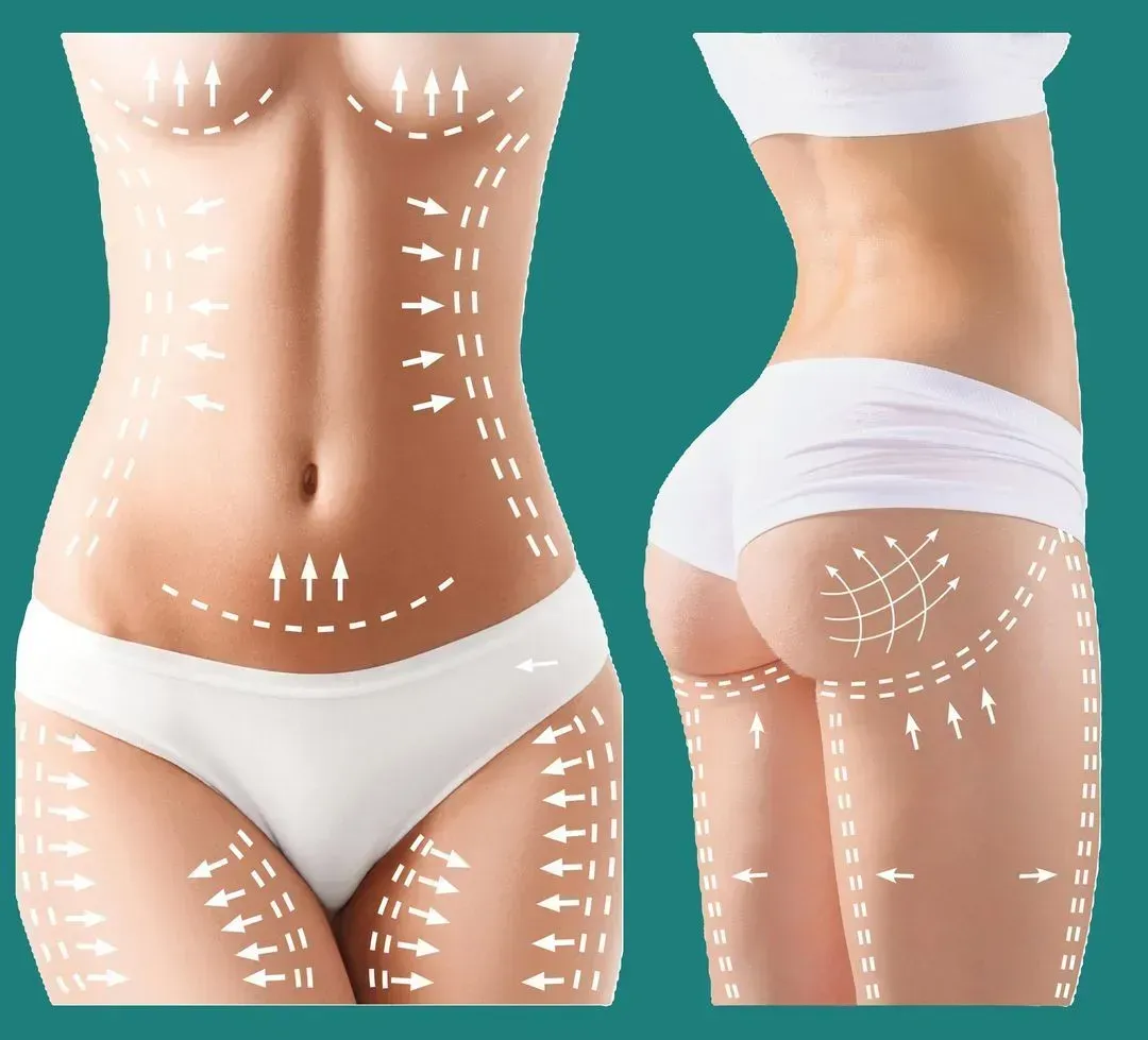 Diagram of a body marked with surgical lines and arrows, indicating areas for cosmetic procedures.