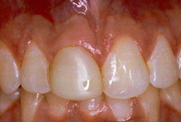 Close-up of healthy gums and teeth after cosmetic dental treatment