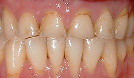 Close-up of teeth with visible gap before cosmetic dental work