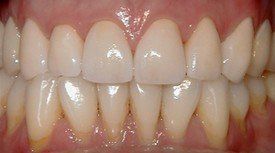 Close-up showing dental crowns or veneers with color mismatch