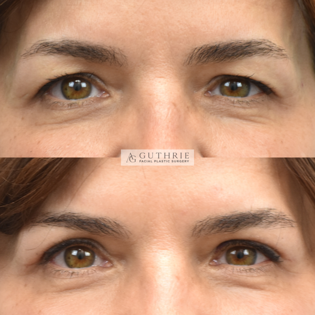 Upper Blepharoplasty - Real Patient Before & After
