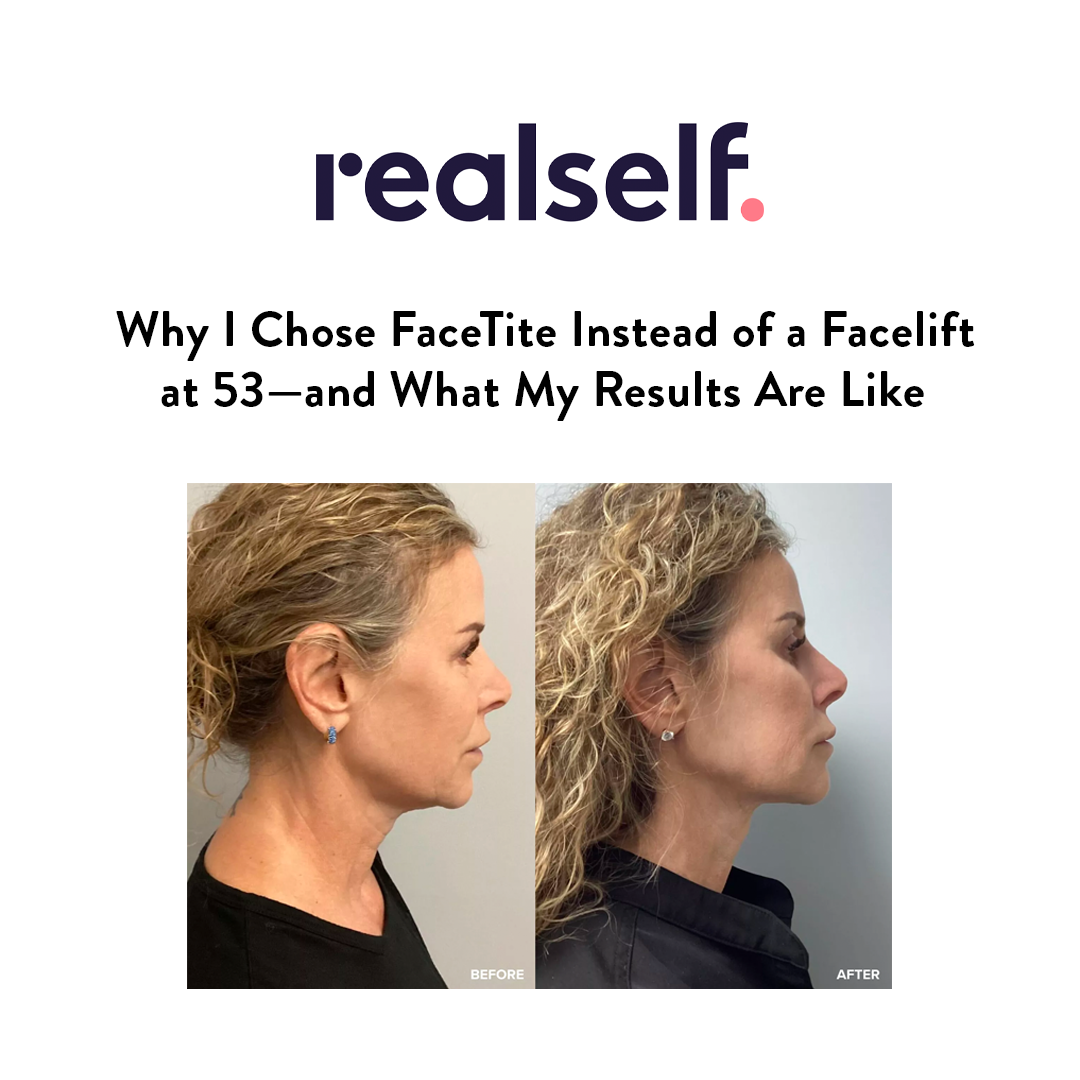 Why i chose facetite instead of a facelift at 53 and what my results are like.