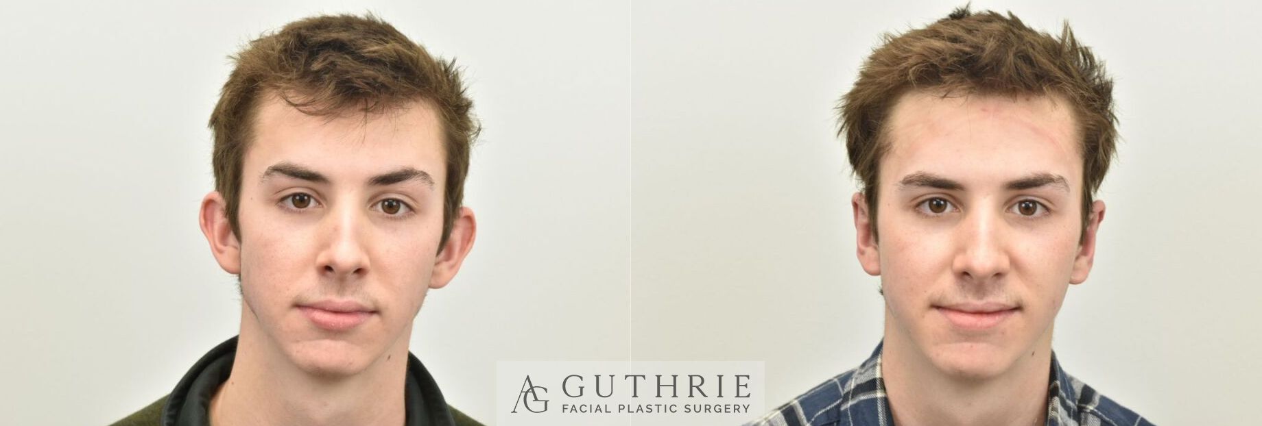 Before and After Otoplasty