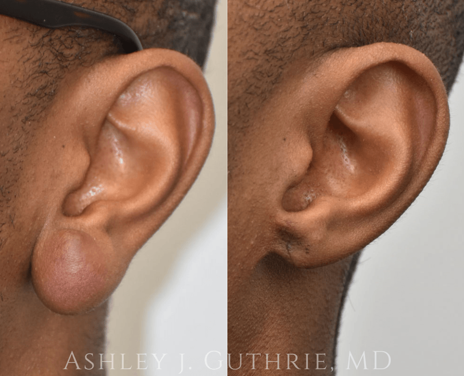 closeup of ears Before and After Earlobe Repair