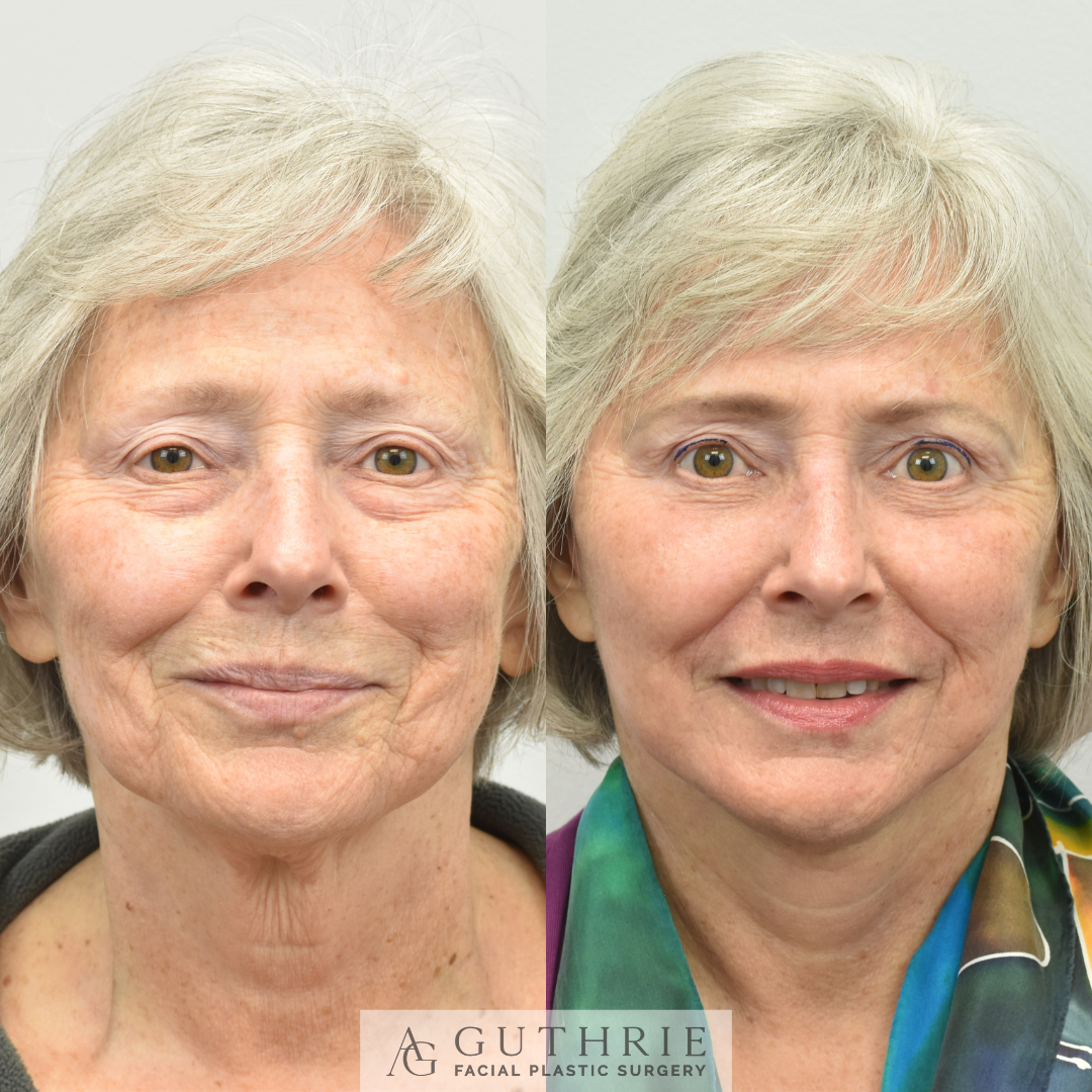 Before and After Lower Blepharoplasty
