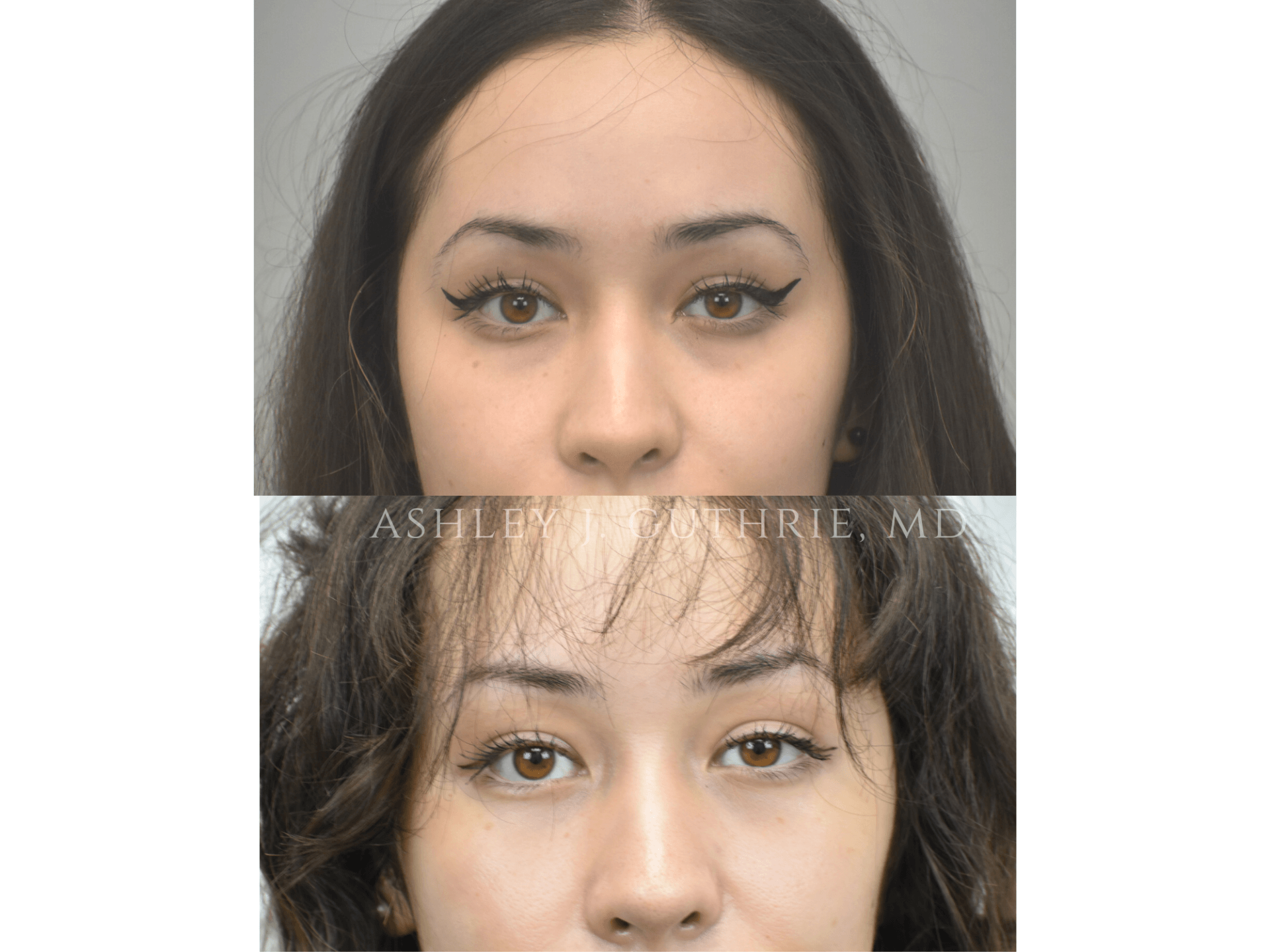 Blepharoplasty - Before and After