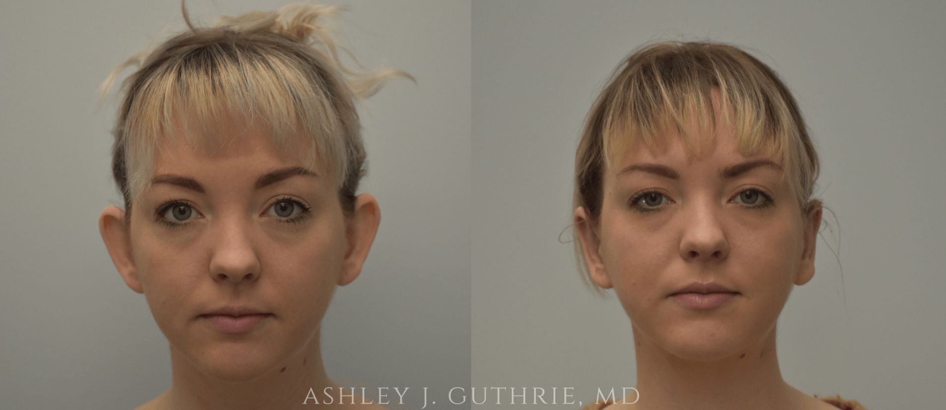 Before and After Otoplasty
