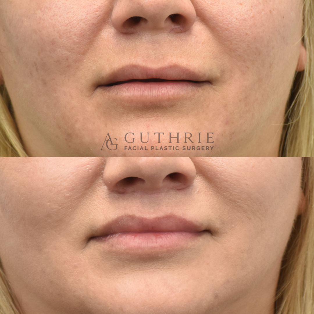 Before and After Subnasal Lip Lift