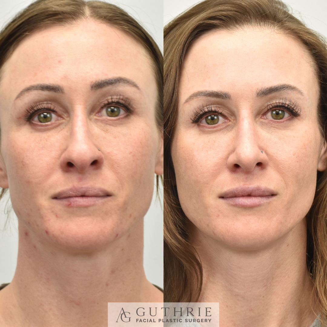 Before and After Rhinoplasty