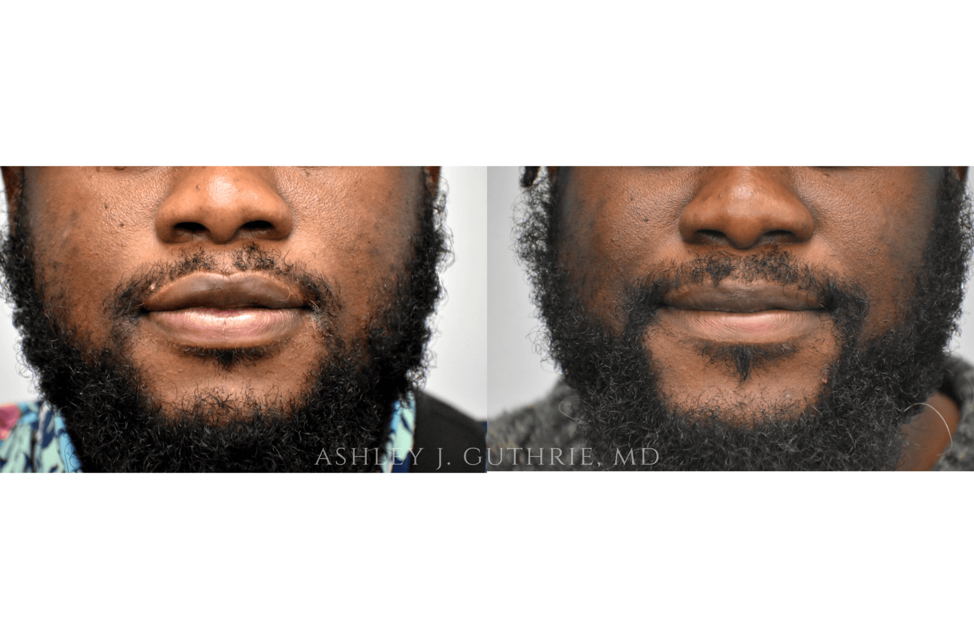 lip reduction