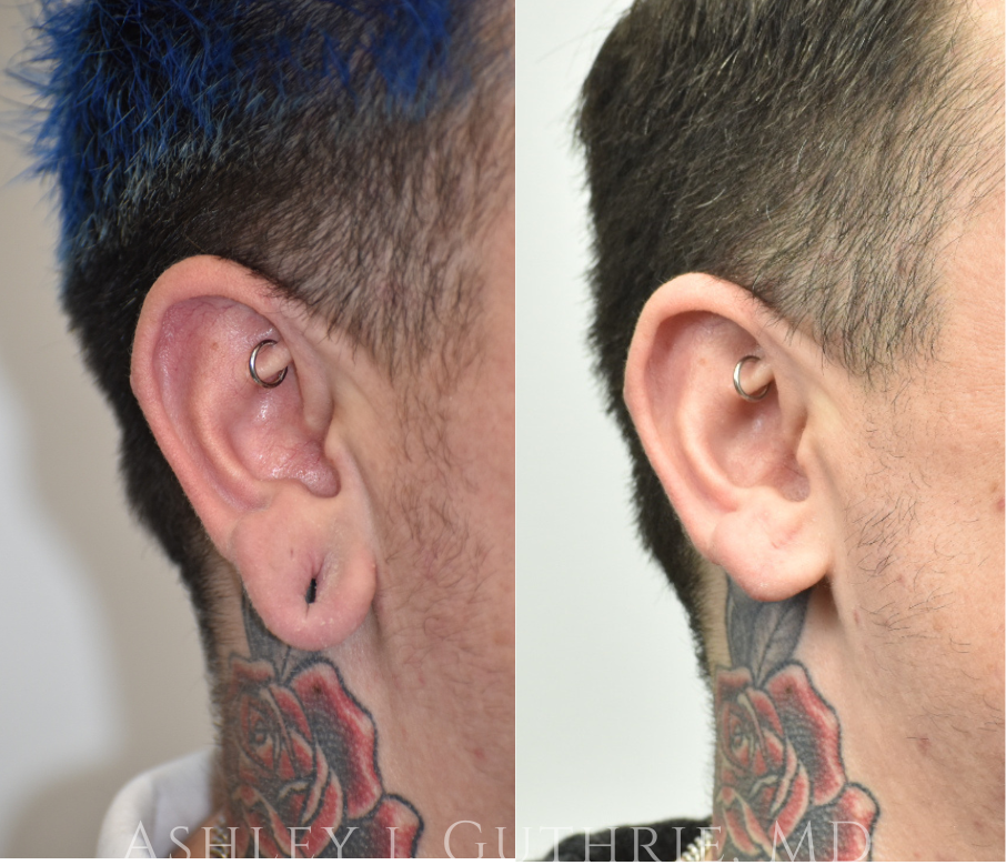 Before and 6 Weeks After Gauge Earlobe Repair