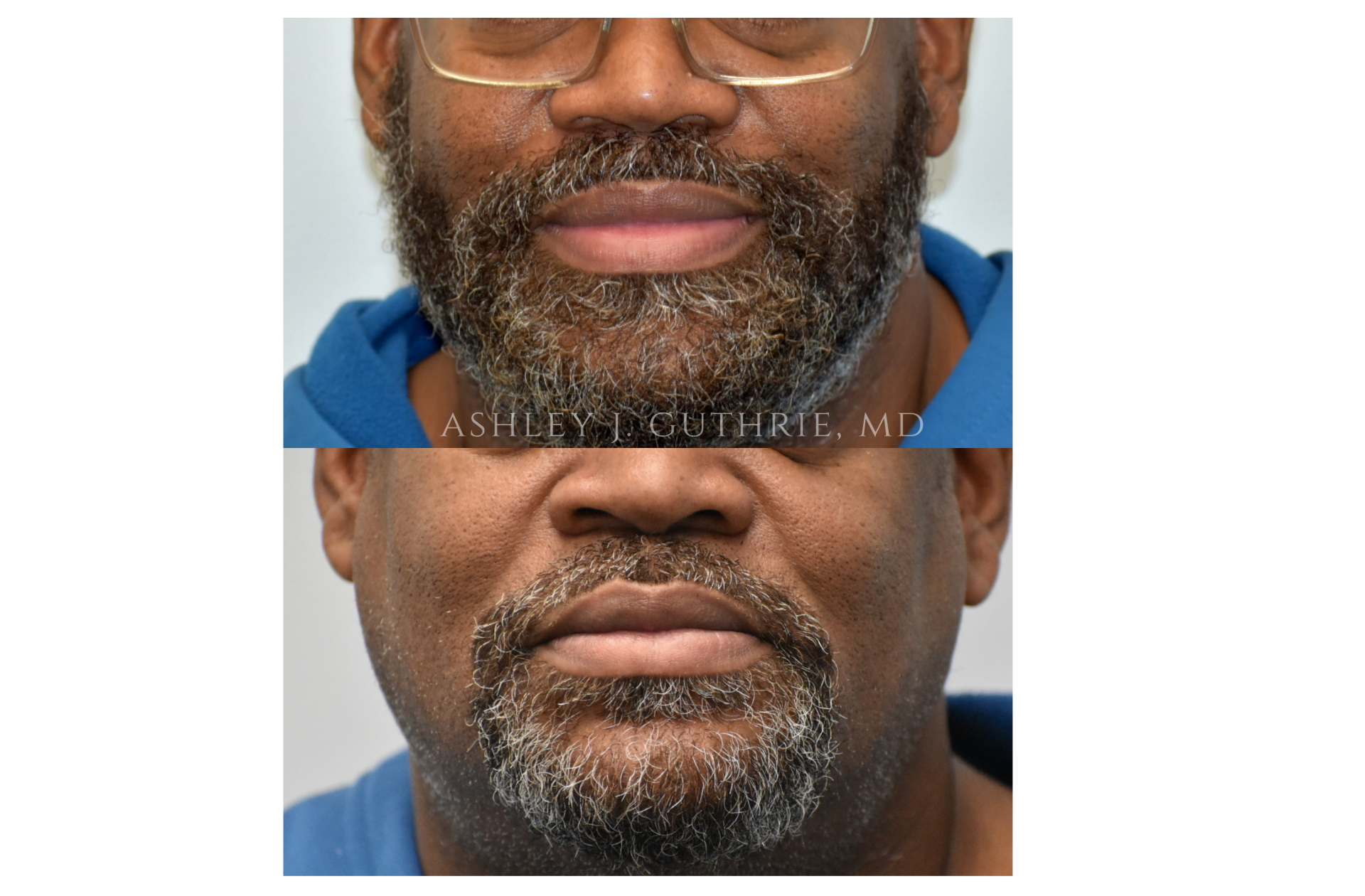 lip reduction