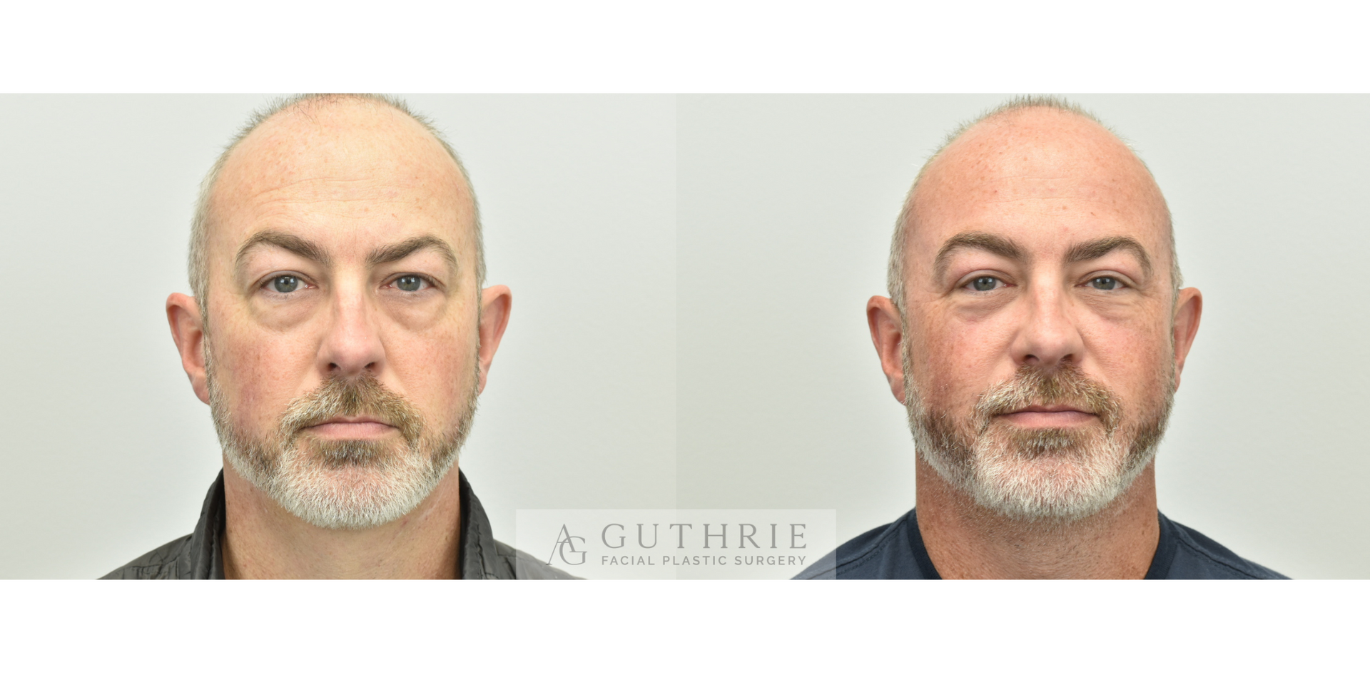 Blepharoplasty - Before and After