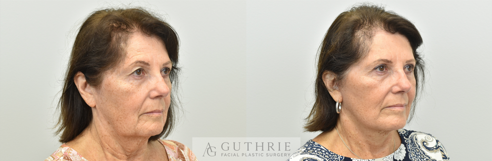 Before and After Facelift, Upper Blepharoplasty, Endoscopic Brow Lift, and CO2 Laser