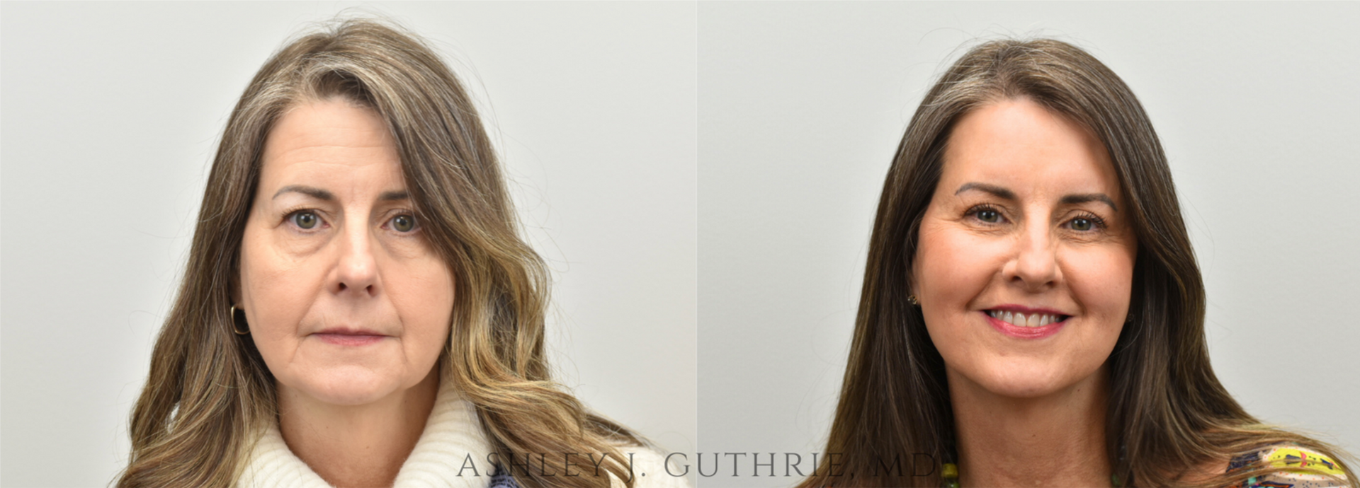 Facelift / Deep Plane - Before & After