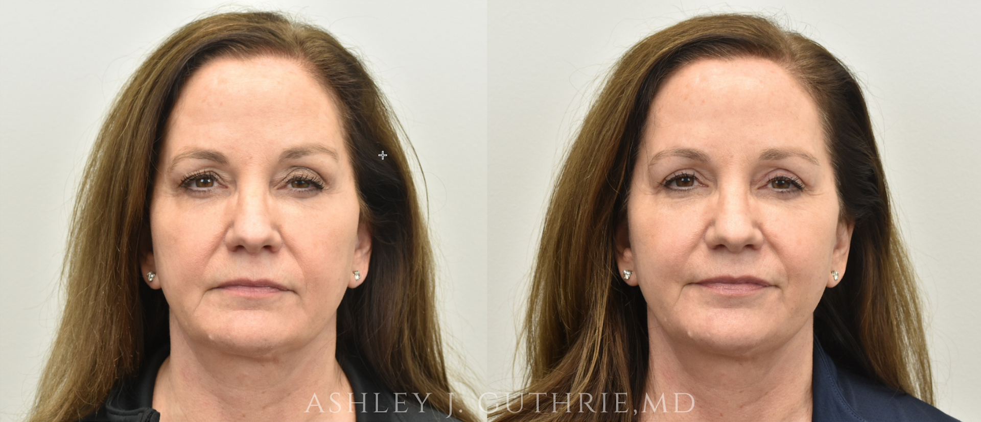 Before and After Upper Blepharoplasty