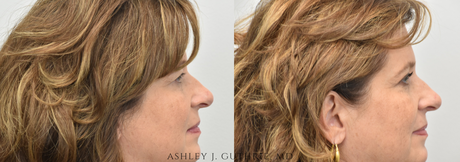 Blepharoplasty - Before and After