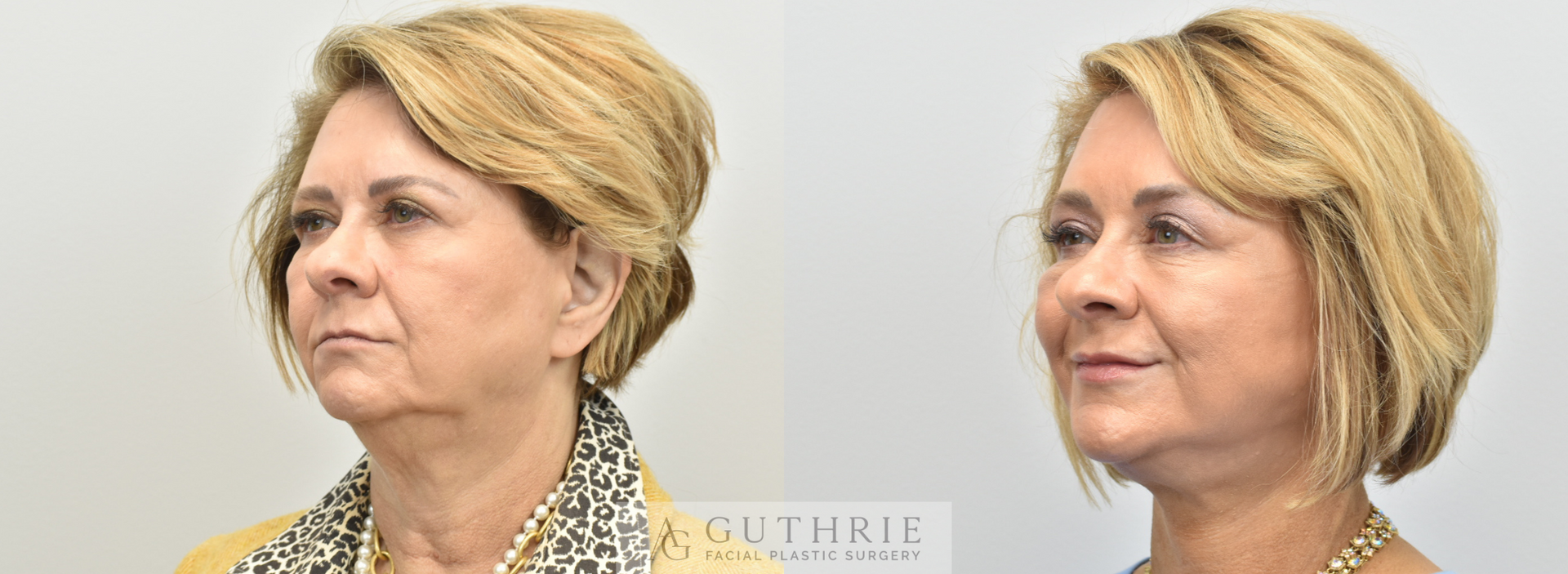 Before and After Facelift, Brow Lift, and Lower Blepharoplasty