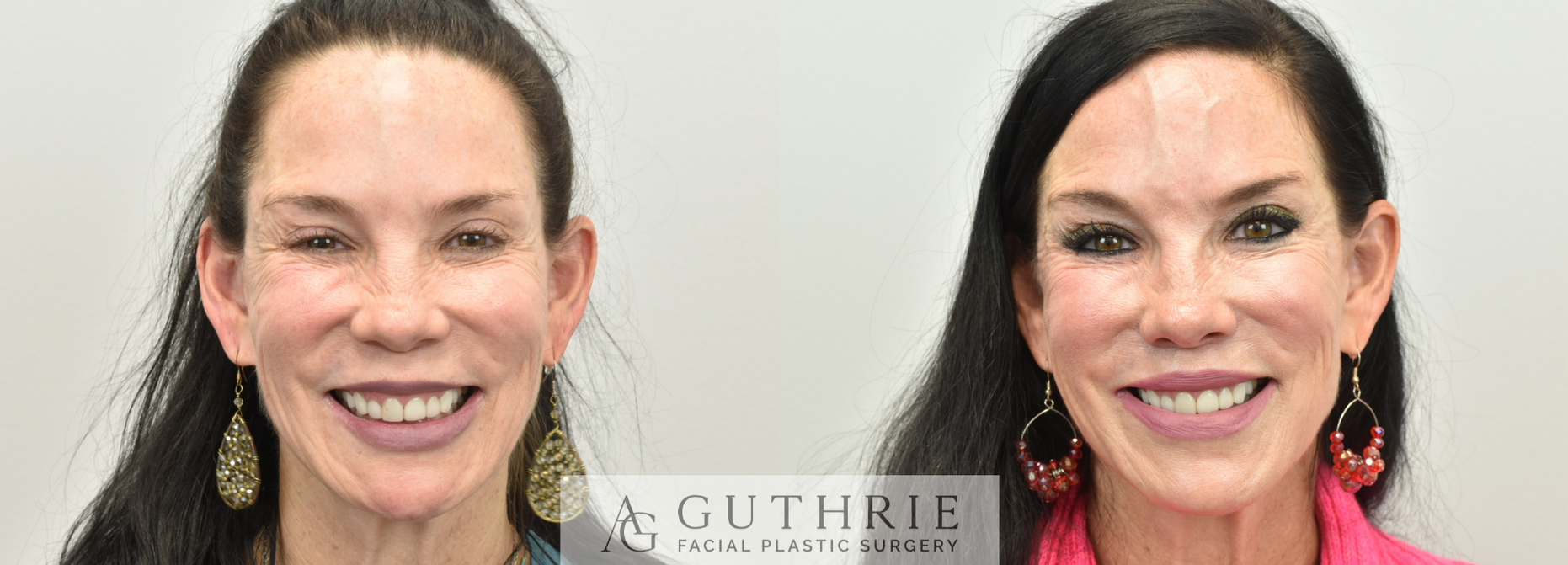 Before and After Subnasal Lip Lift, Upper and Lower Lip Implant Removal