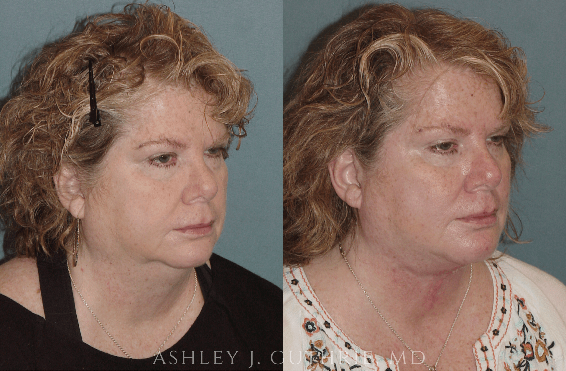 Before and 6 Weeks After Direct Submental Cervicoplasty and Chin Implant