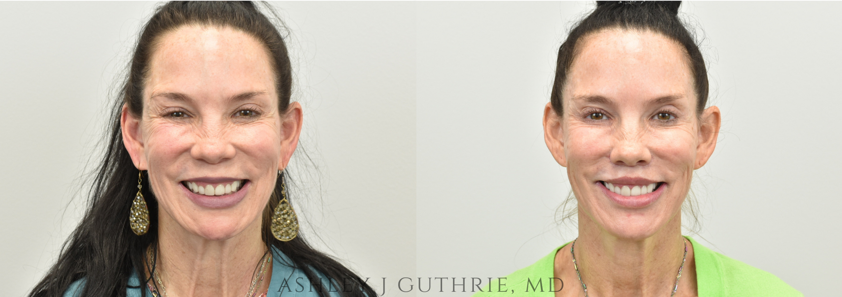 Lip Lift by Ashley Guthrie MD - Facial Plastic Surgeon