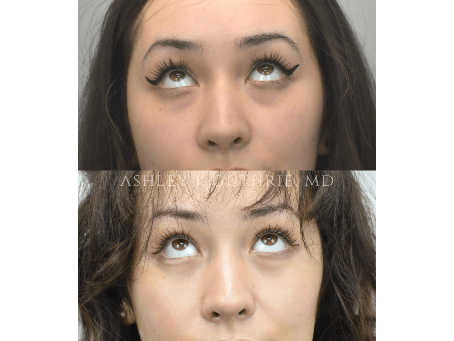 Blepharoplasty - Before and After