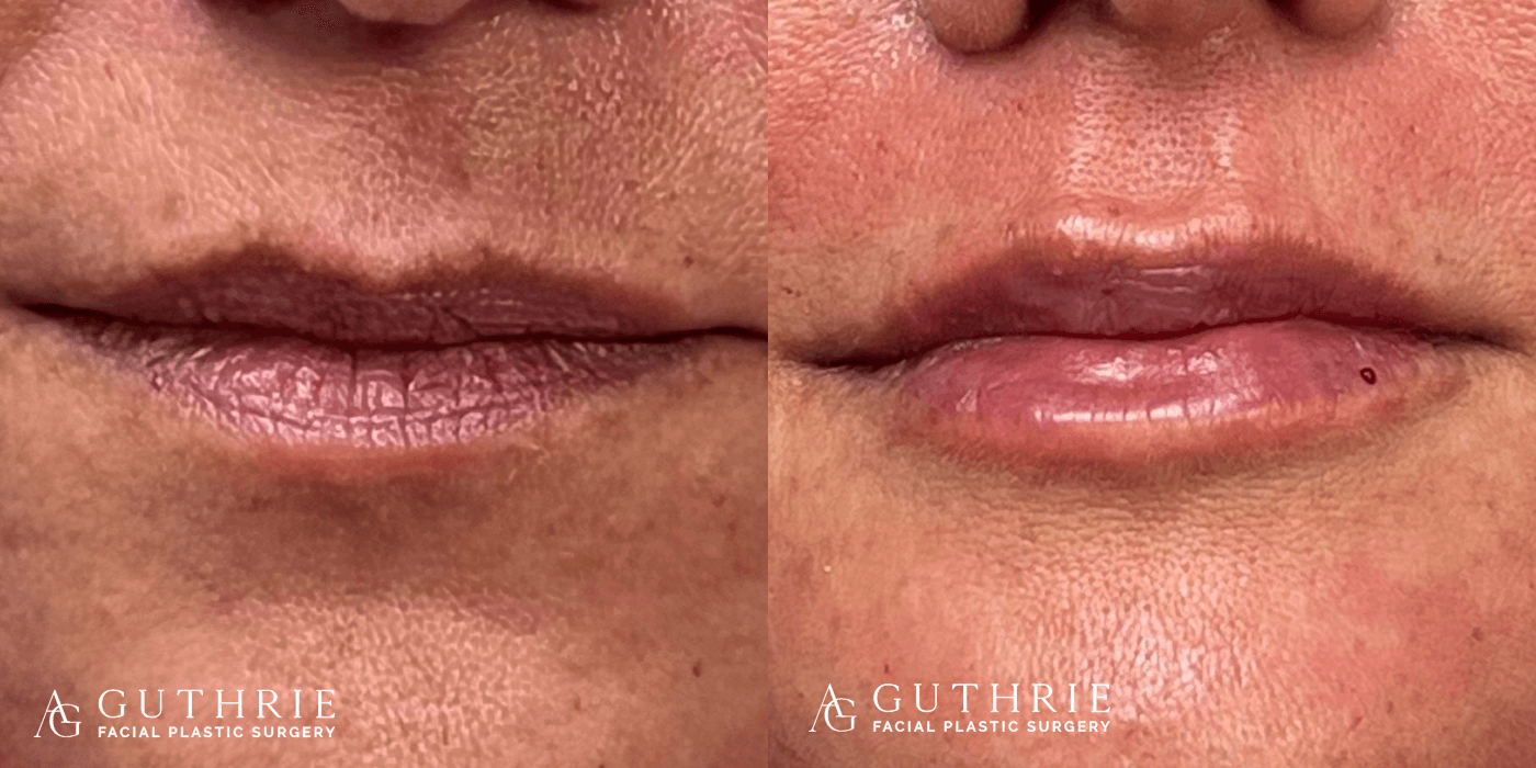 Before and After Lip Fillers