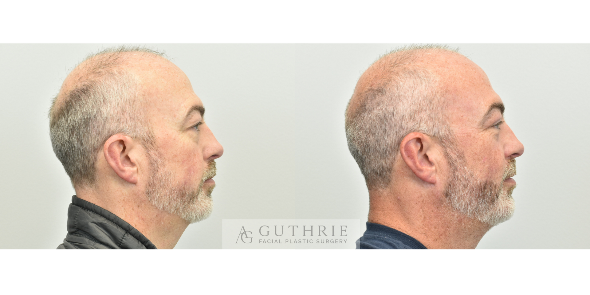 Blepharoplasty - Before and After