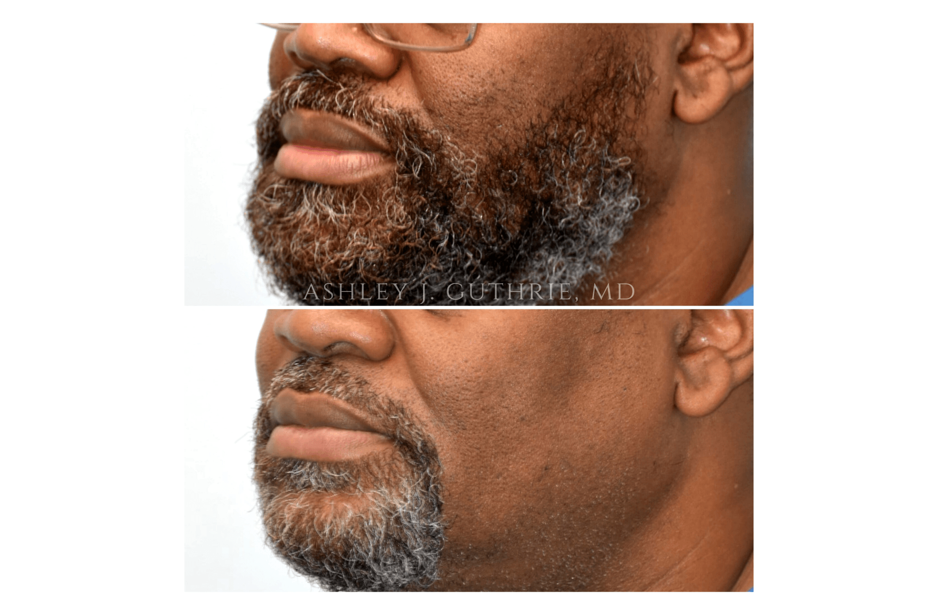 lip reduction
