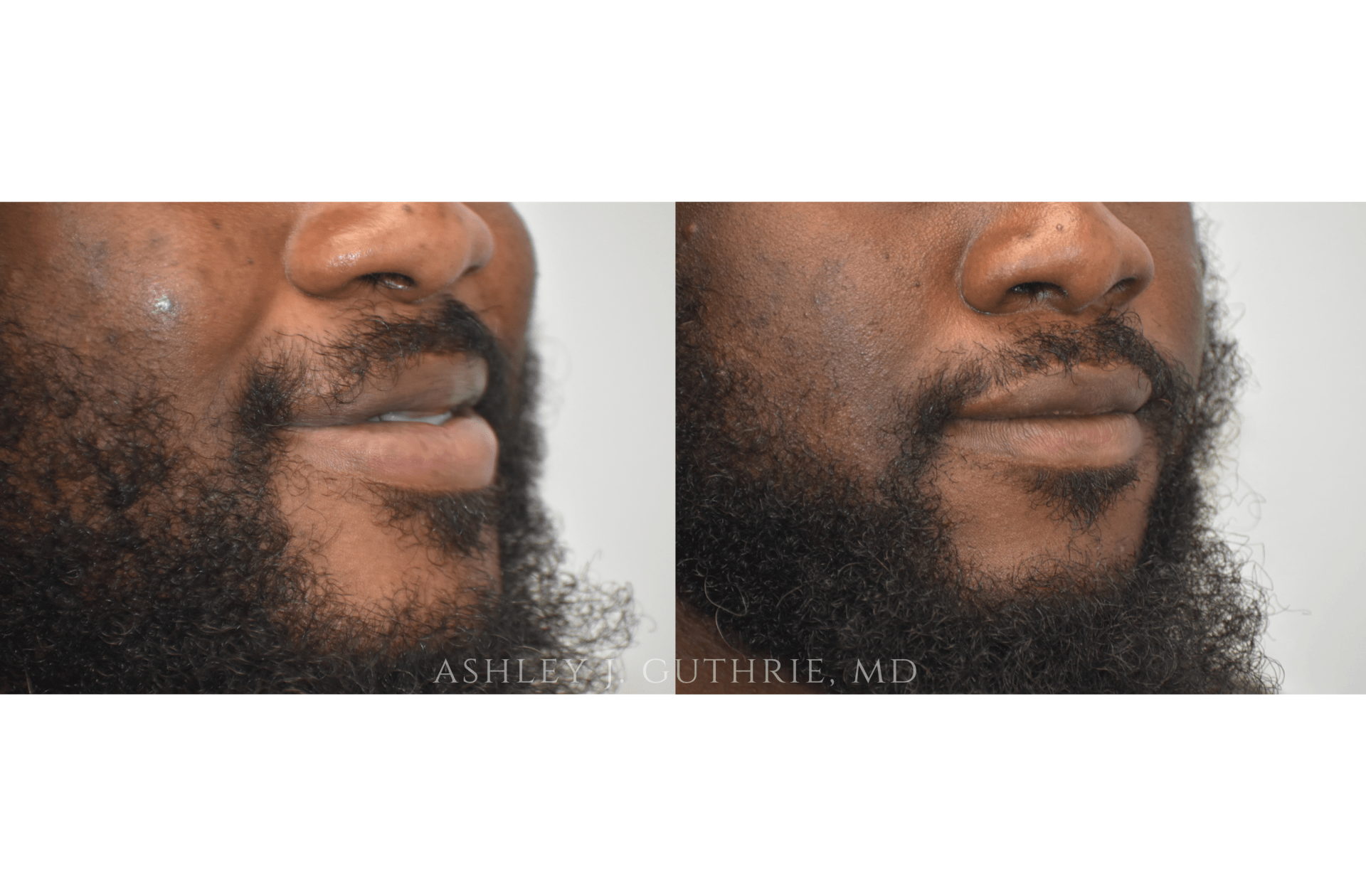 lip reduction