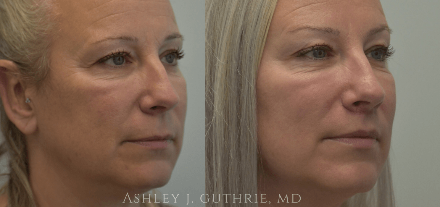 before and after pictures of female lip flip patient