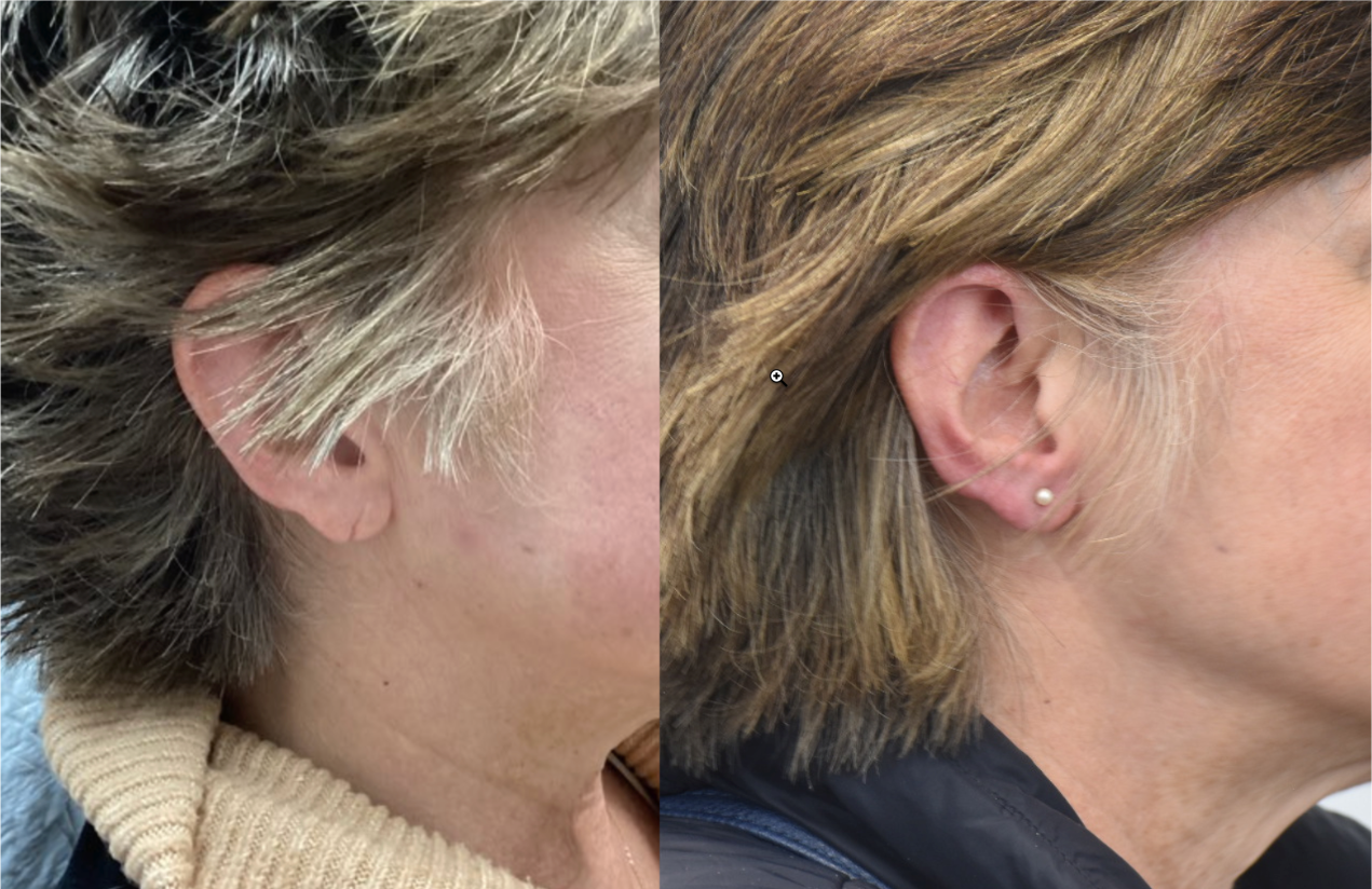 Before and After Earlobe Repair