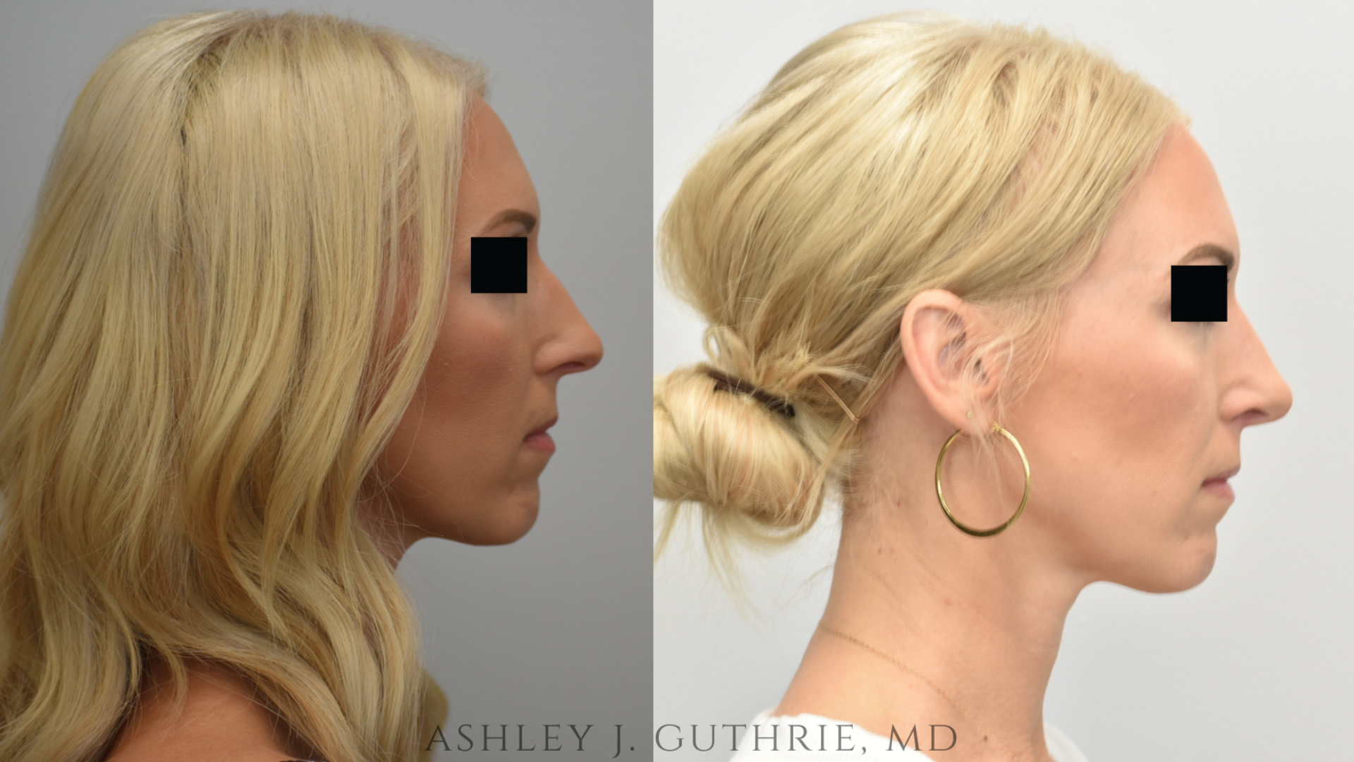 Before and After Rhinoplasty
