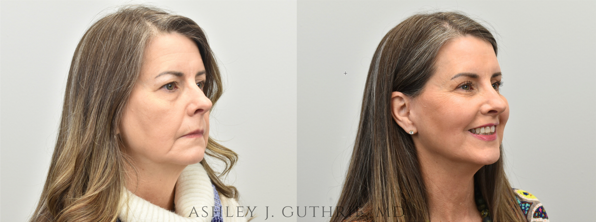 Before and After Facelift, Endoscopic Brow Lift, Upper Blepharoplasty, and Lip Lift