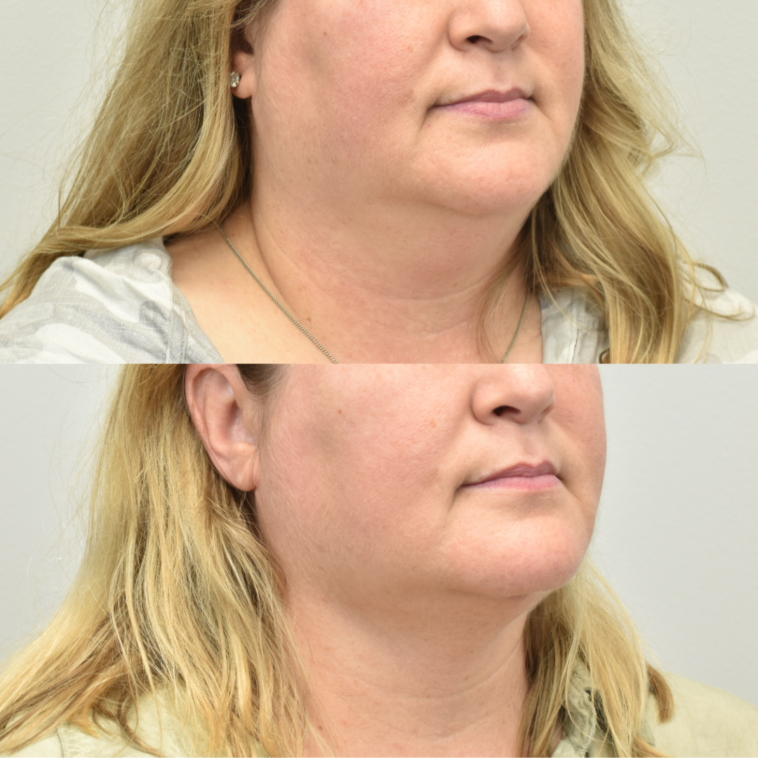 Before and After FaceTite Treatment