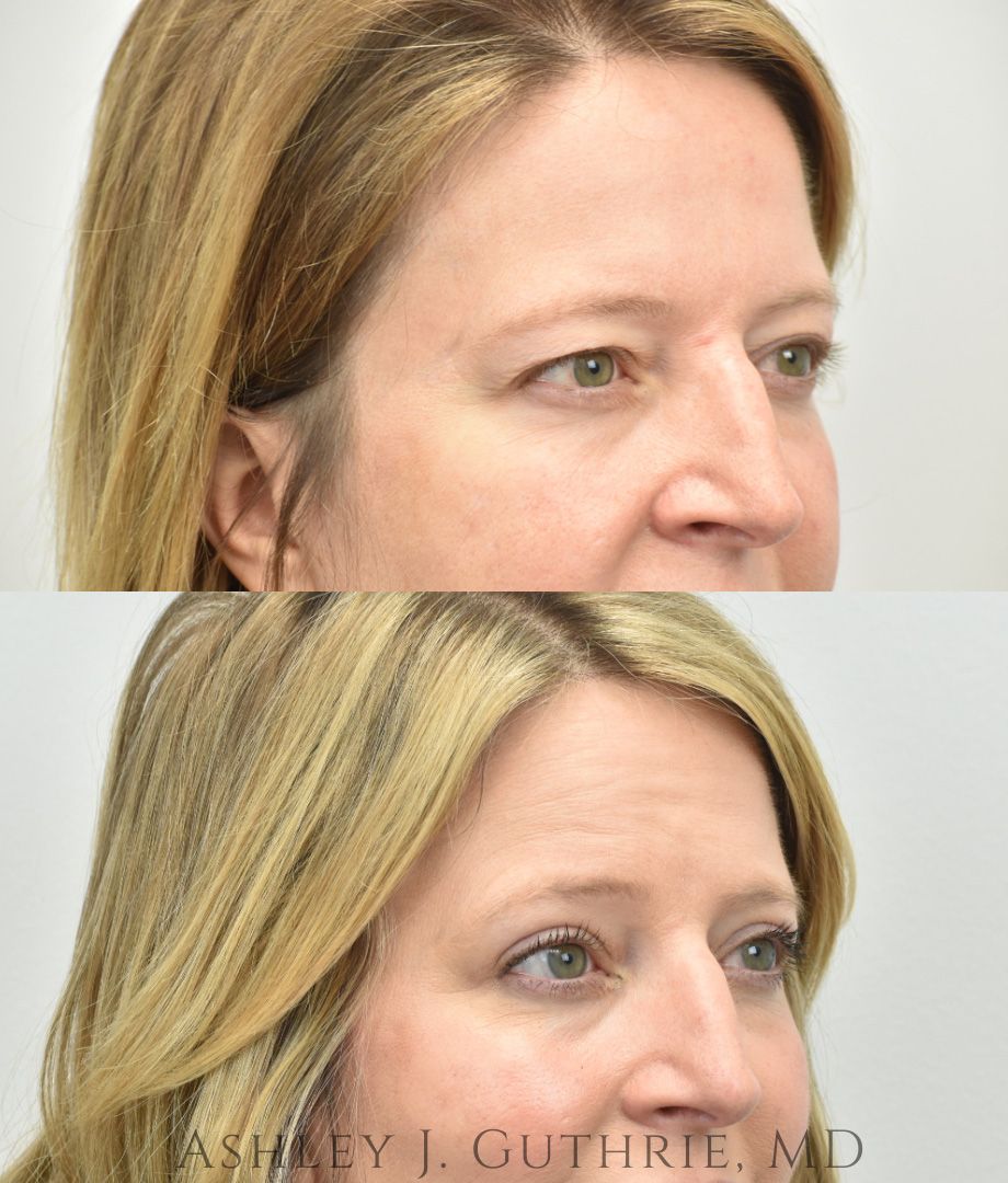 a woman before and after blepharoplasty