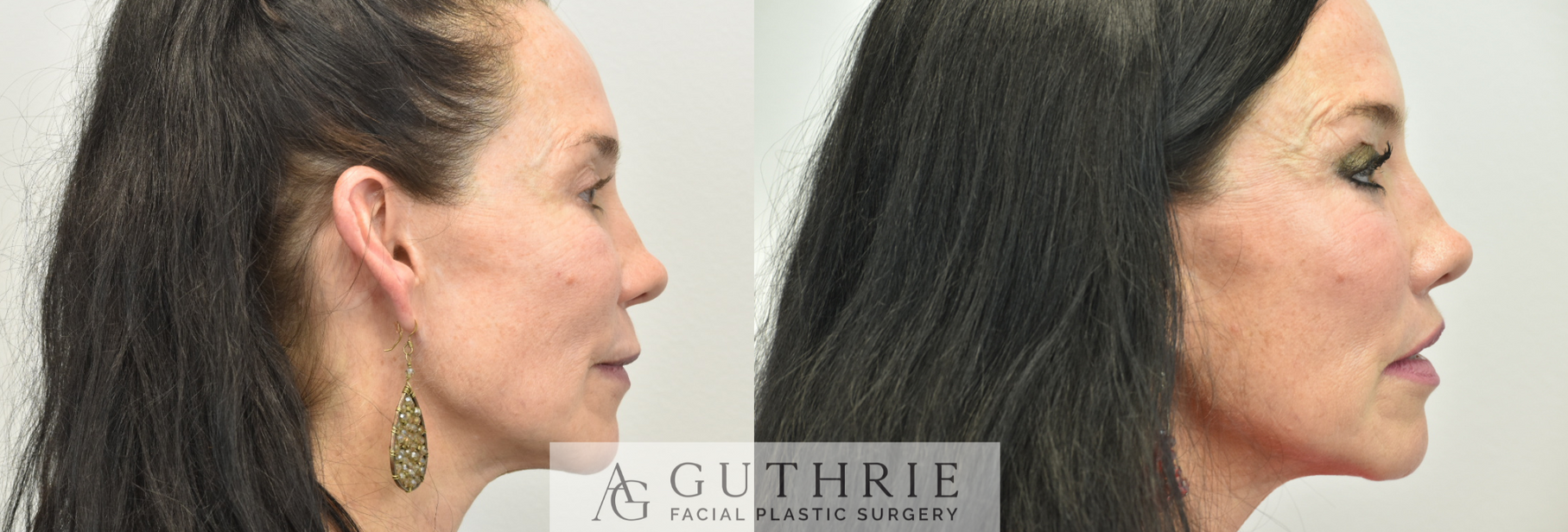 Before and After Subnasal Lip Lift, Upper and Lower Lip Implant Removal