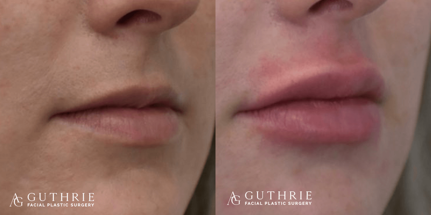 Before and After Lip Fillers