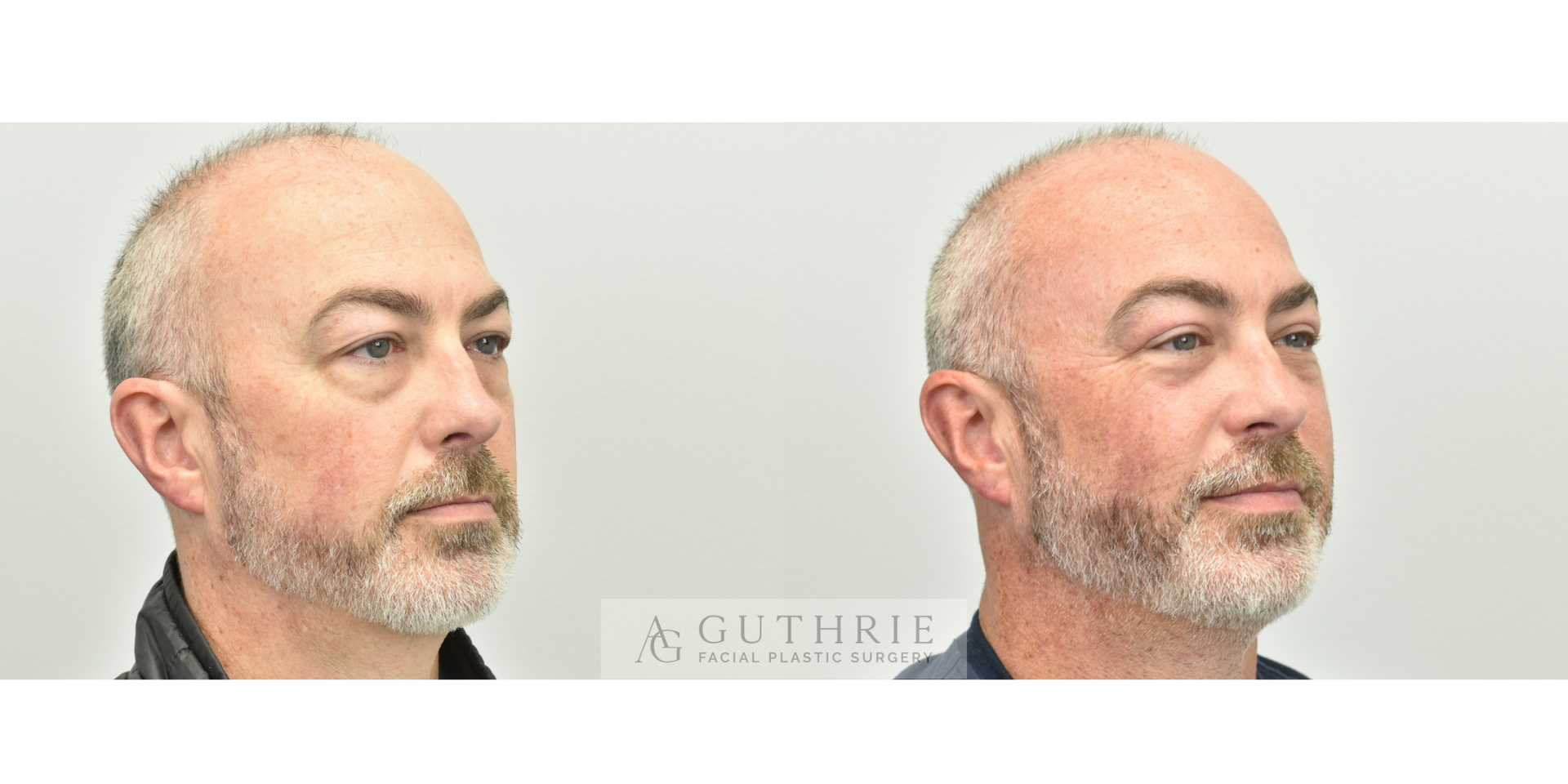 Blepharoplasty - Performed by Ashley Guthrie MD - Facial Plastic Surgeon - Brentwood/Nashville TN