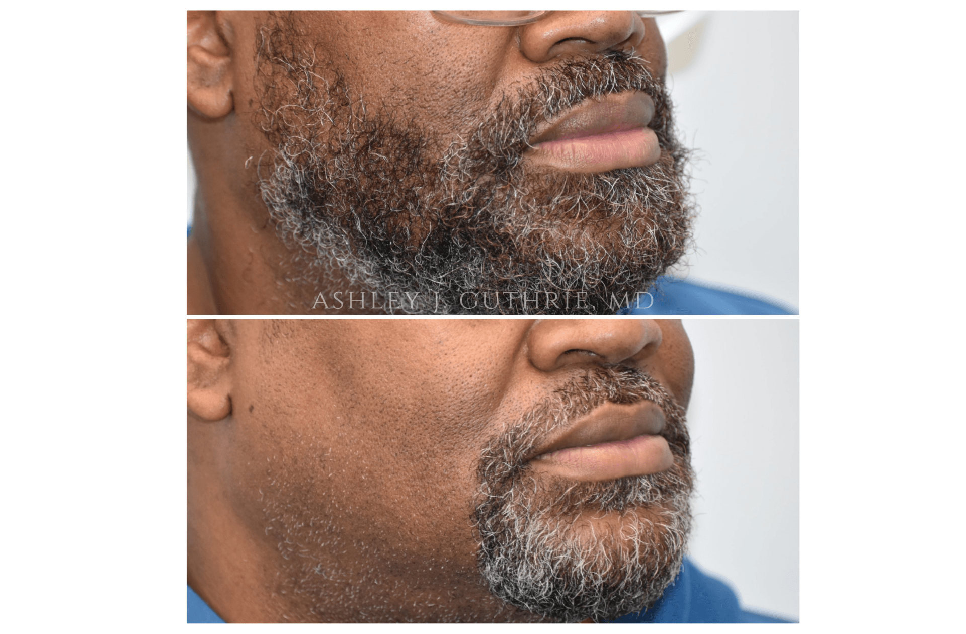 lip reduction
