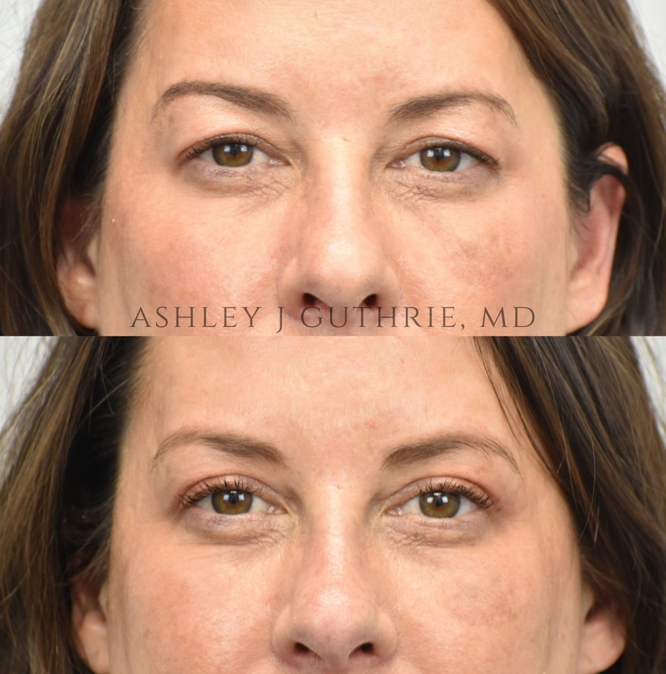Before and After Upper Blepharoplasty