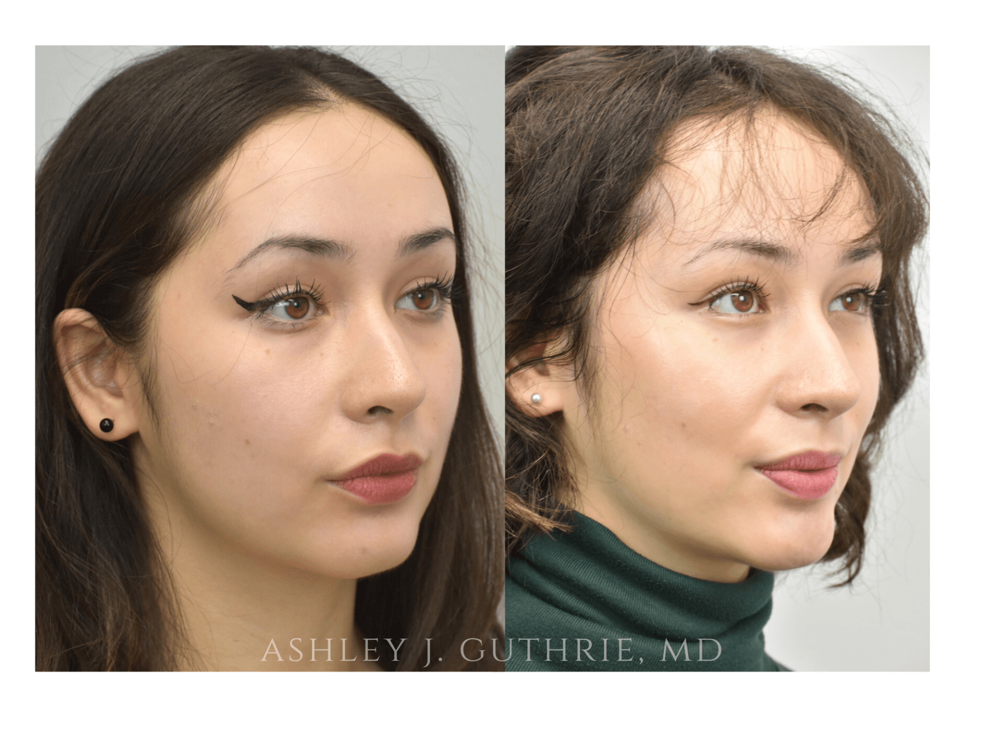 lower blepharoplasty