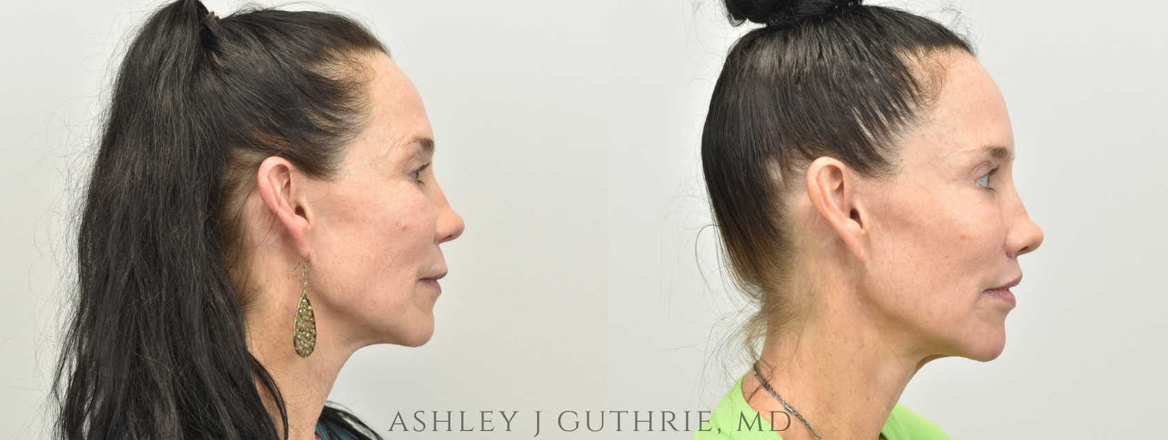 Lip Lift