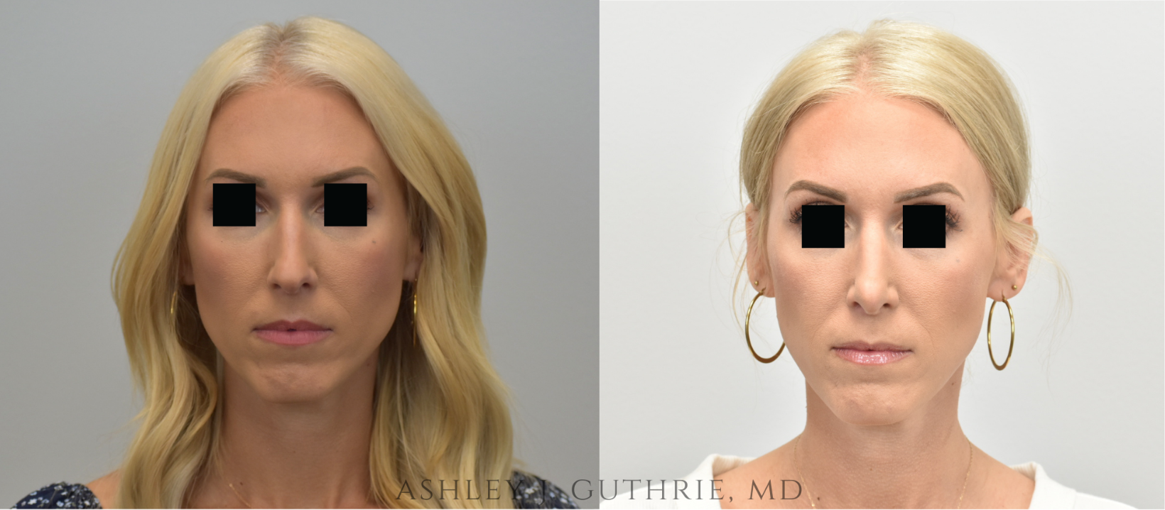 a woman before and after rhinoplasty