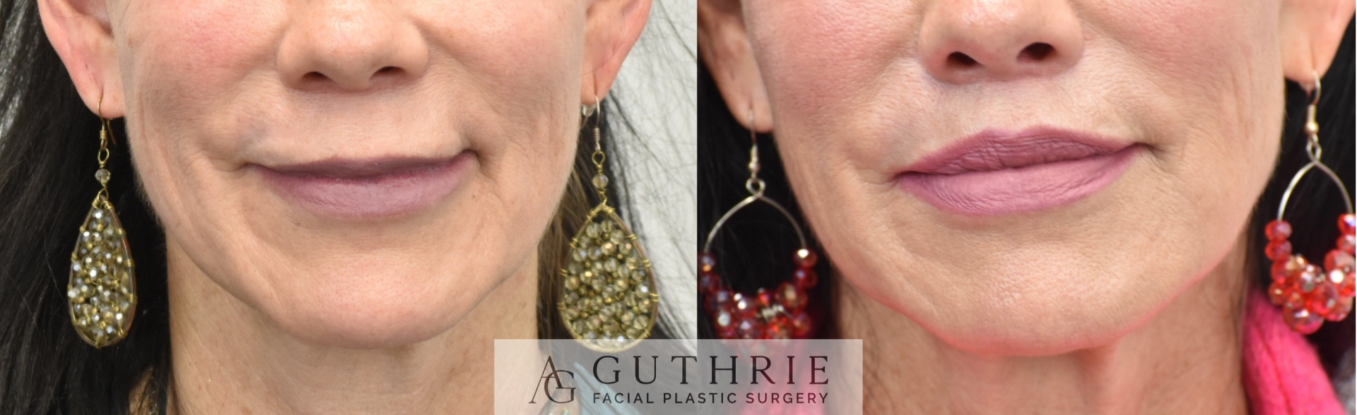 Before and After Subnasal Lip Lift, Upper and Lower Lip Implant Removal