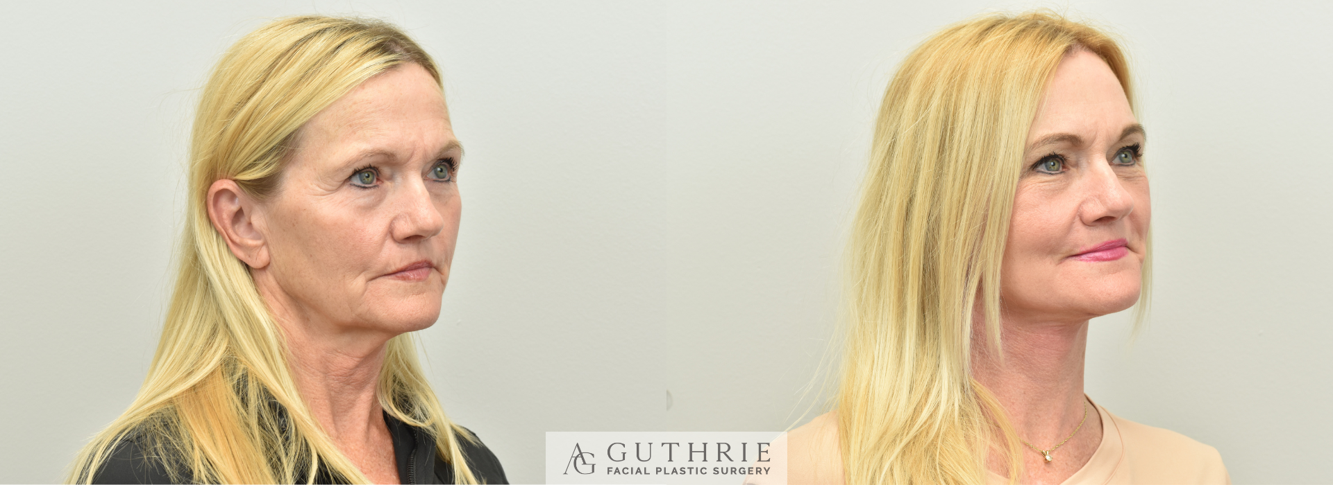 Before and After Deep Plane Face and Neck Lift, Brow Lift, and CO2 Laser